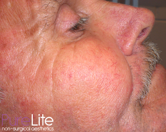 Image of male client cheek after removal of spider veins
