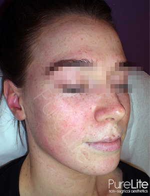 Image of full face after freckle removal