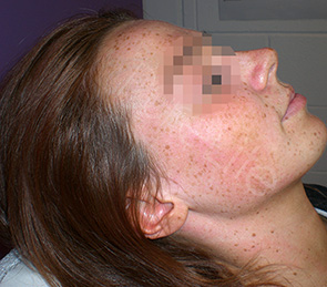 Image of female client right cheek before freckle removal treatment