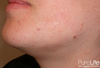 Image of female chin and neck after hair removal treatment