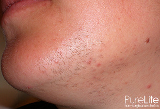 Image of female client with hair on chin