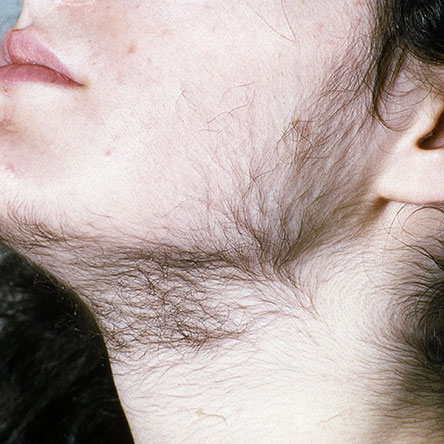 Image of female Hirsutism due to PCOS