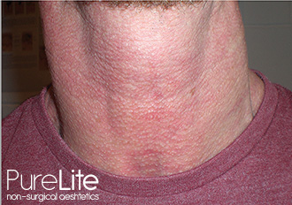 Rosacea on male neck