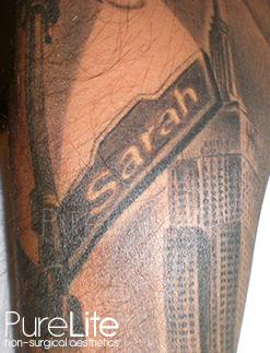 image of tattoo before removal