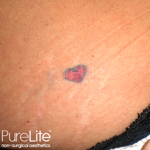 image of tattoo after removal