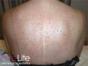 Freckl Removal Before Treatment on Back