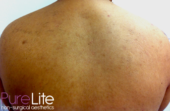 Image of male back after hair removal