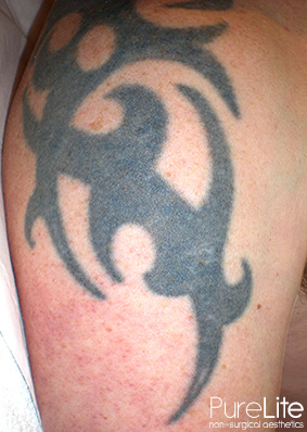 image of tattoo before fading