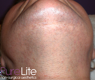 Image of client neck before hair removal