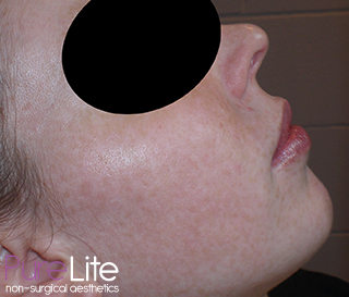 Image of female client right cheek after freckle removal treatment