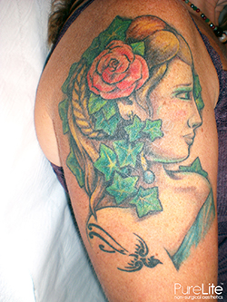 Image of tattoo removal fading