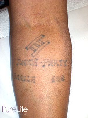 image of tattoo before removal