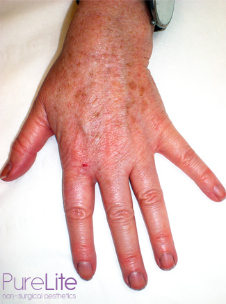 Image of left hand before pigmentation removal