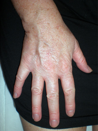 Image of right hand after pigmentation removal