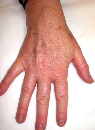 Image of left hand before pigmentation removal