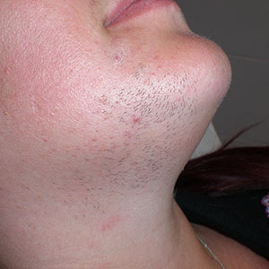 Image of client with hair on chin and nexk before laser hair removal treatment