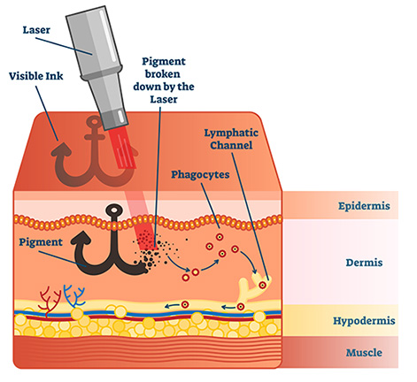 Image showing how laser tattoo removal works