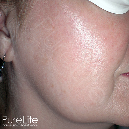 Image of female client right cheek after thread vein removal
