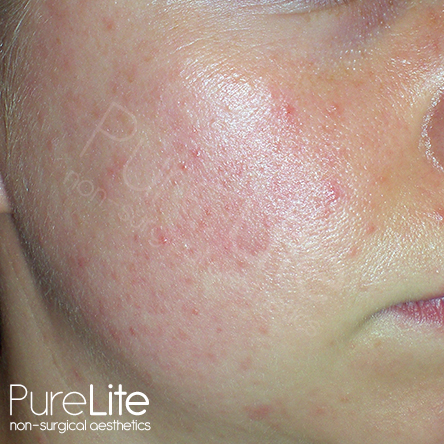 Image of a cheek with Rosacea
