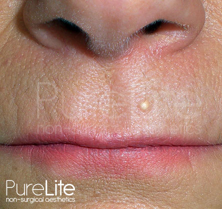 Image of a Milia on a client upper lip before removal.