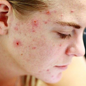 Image of female with Acne