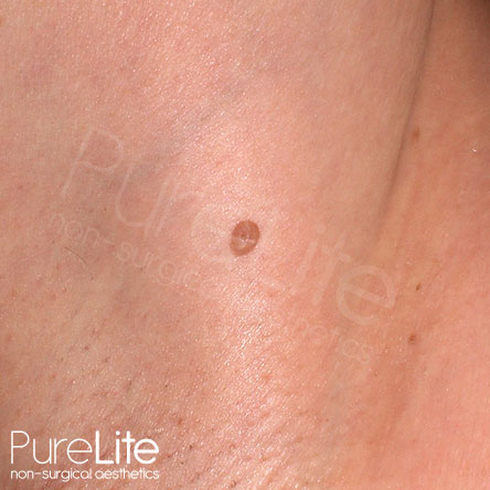 Image of skin tag on underarm